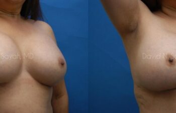 Breast Augmentation Before and After | Sayah Institute