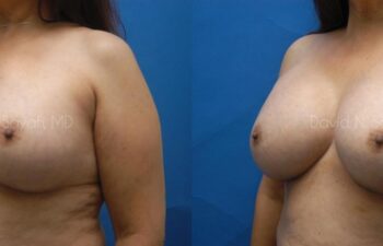 Breast Augmentation Before and After | Sayah Institute