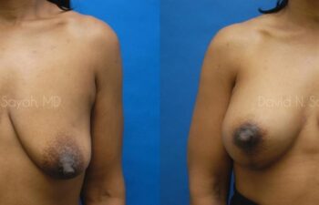 Breast Reconstruction Before and After | Sayah Institute