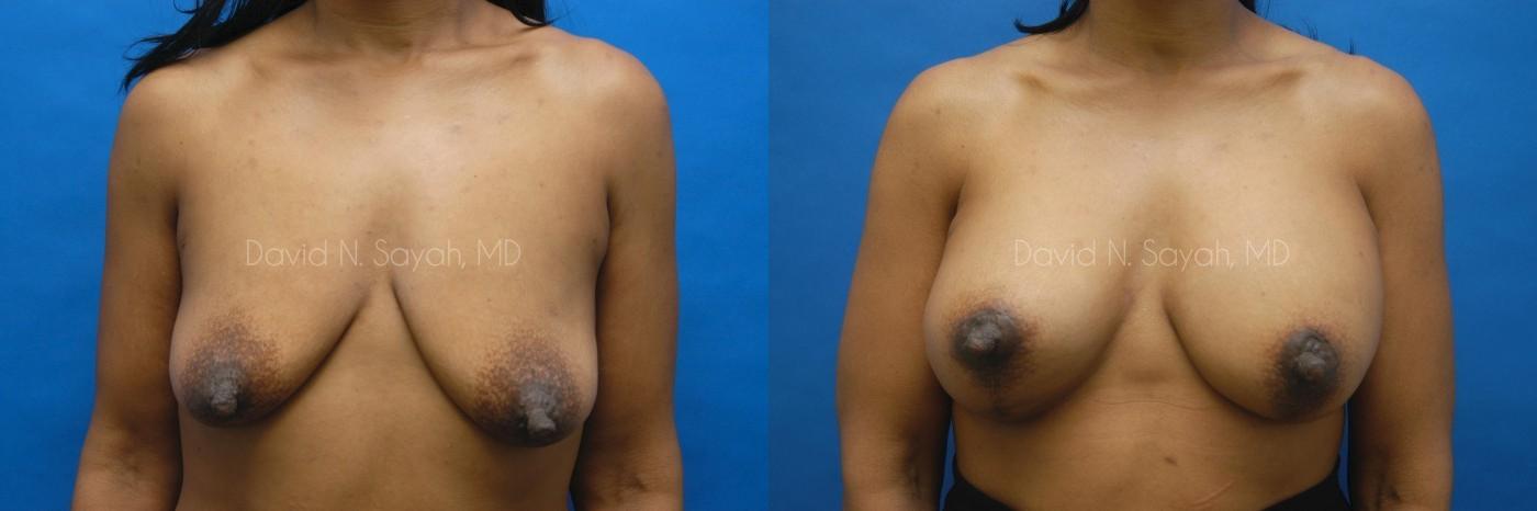 Breast Reconstruction Before and After | Sayah Institute