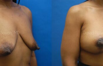 Breast Reconstruction Before and After | Sayah Institute