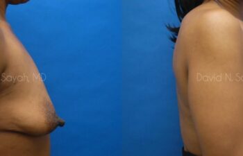 Breast Reconstruction Before and After | Sayah Institute