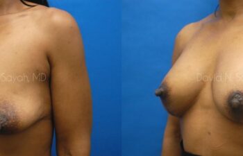 Breast Reconstruction Before and After | Sayah Institute