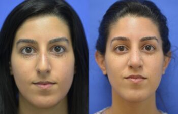 Rhinoplasty Before and After | Sayah Institute