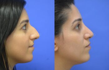 Rhinoplasty Before and After | Sayah Institute