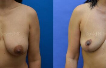 Breast Reconstruction Before and After | Sayah Institute