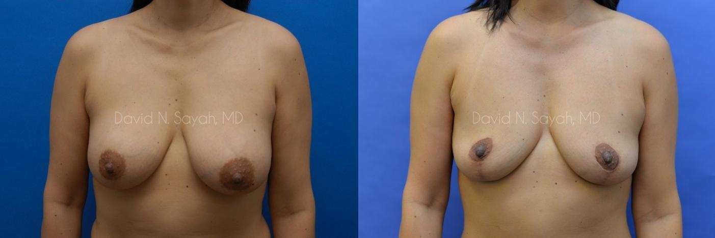 Breast Reconstruction Before and After | Sayah Institute