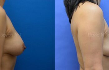 Breast Reconstruction Before and After | Sayah Institute