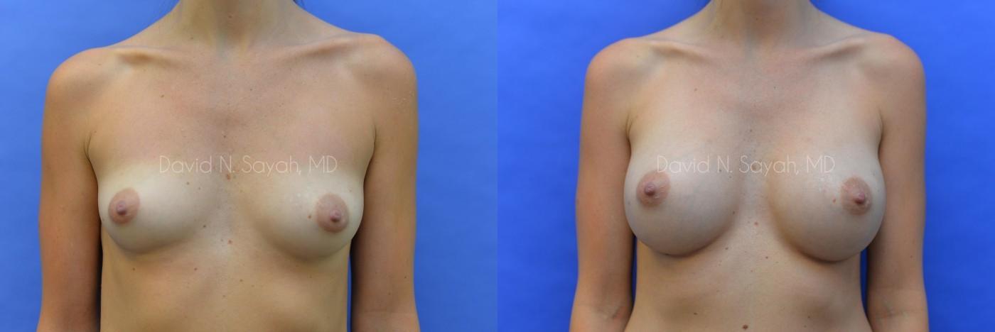 Breast Augmentation Before and After | Sayah Institute