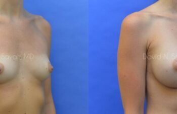 Breast Augmentation Before and After | Sayah Institute