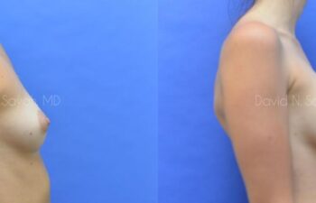 Breast Augmentation Before and After | Sayah Institute