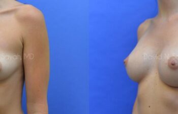Breast Augmentation Before and After | Sayah Institute