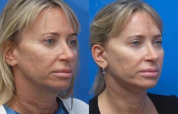 Neck Lift Before and After | Sayah Institute
