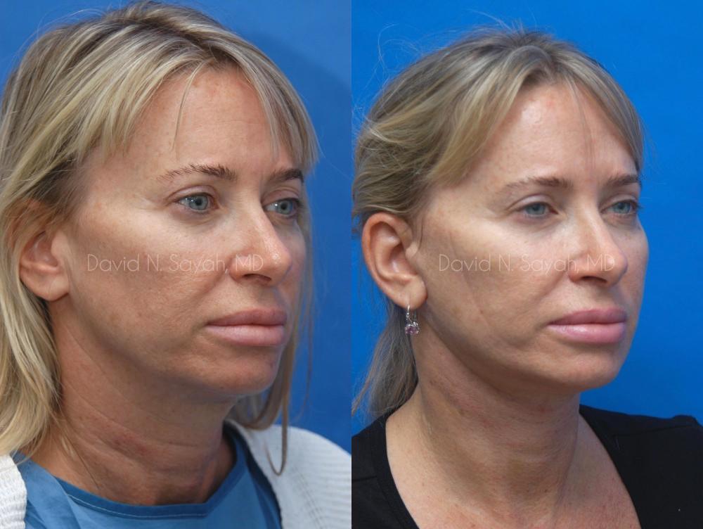 Neck Lift Before and After | Sayah Institute