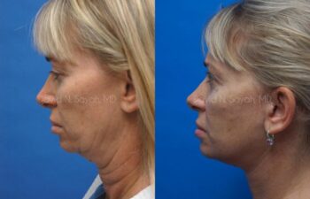 Neck Lift Before and After | Sayah Institute