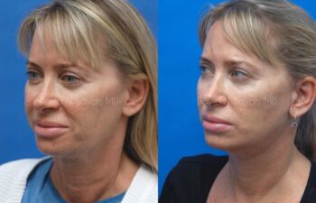 Neck Lift Before and After | Sayah Institute