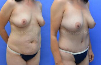 Tummy Tuck Before and After | Sayah Institute