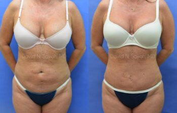 Mini Tummy Tuck Before and After | Sayah Institute