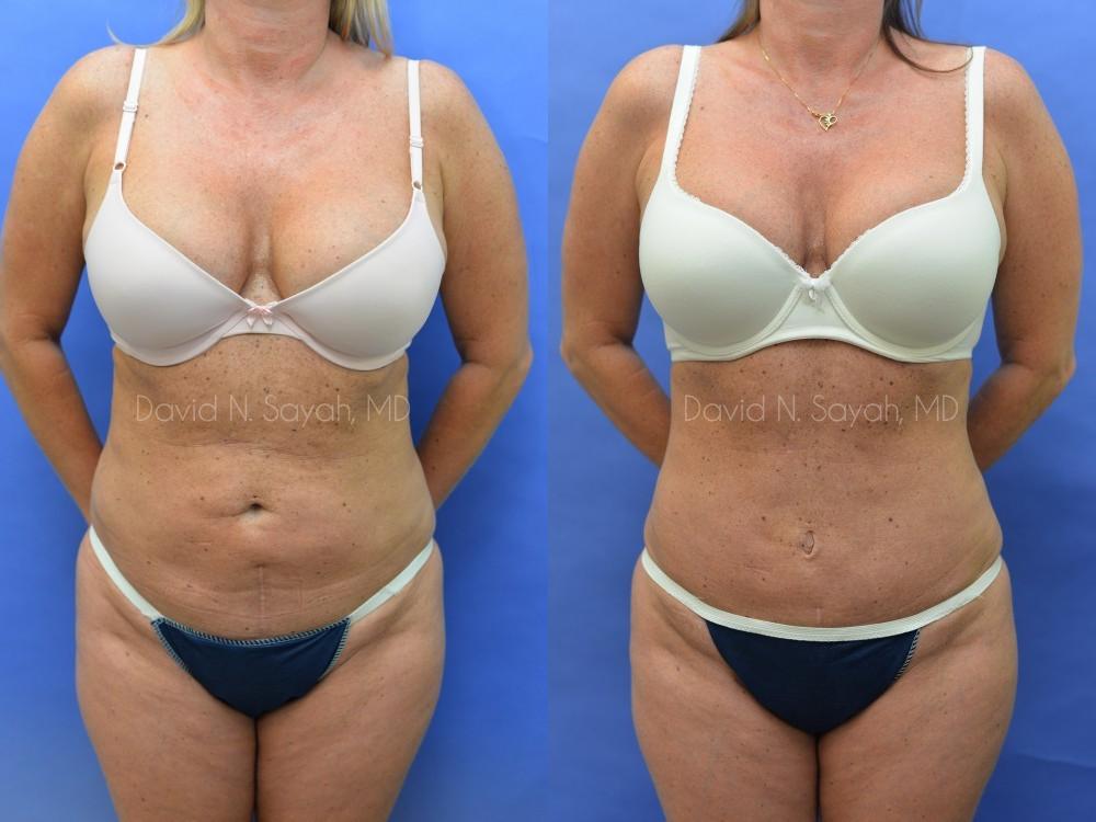 Mini Tummy Tuck Before and After | Sayah Institute