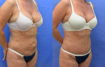 Mini Tummy Tuck Before and After | Sayah Institute