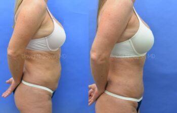 Mini Tummy Tuck Before and After | Sayah Institute