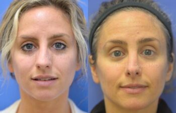 Rhinoplasty Before and After | Sayah Institute