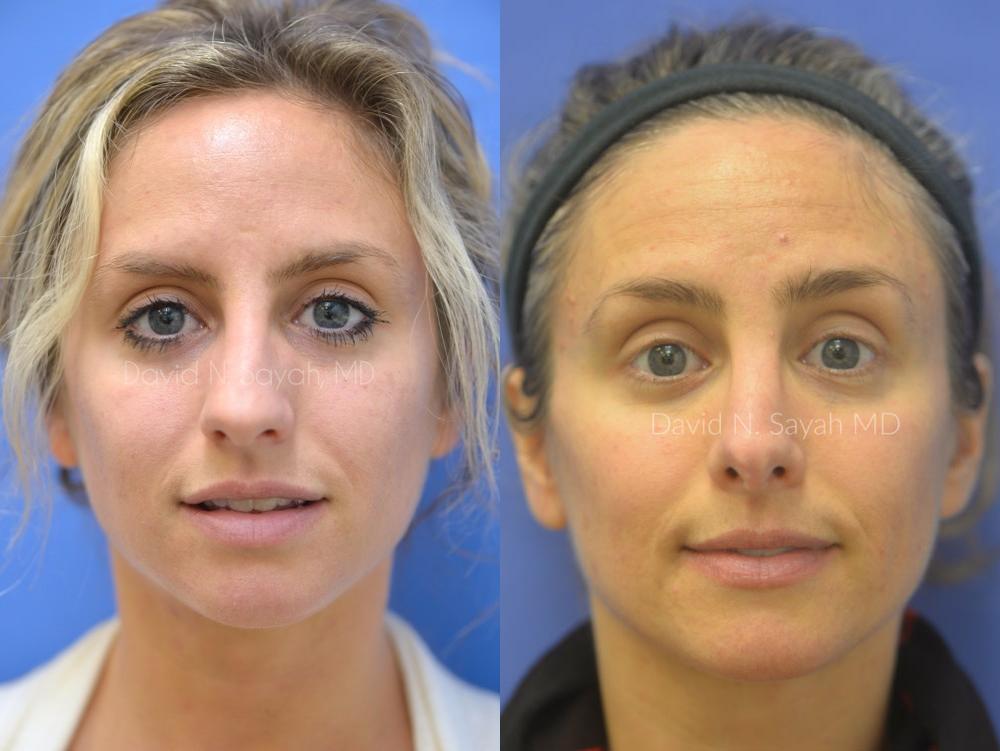 Rhinoplasty Before and After | Sayah Institute