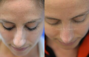 Rhinoplasty Before and After | Sayah Institute