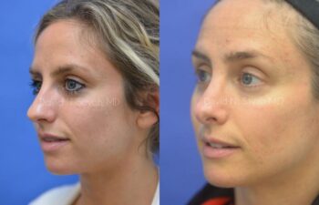 Rhinoplasty Before and After | Sayah Institute