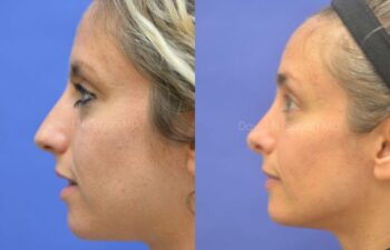 Rhinoplasty Before and After | Sayah Institute