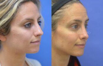 Rhinoplasty Before and After | Sayah Institute
