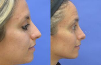Rhinoplasty Before and After | Sayah Institute