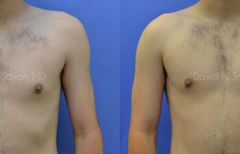 Male Breast Surgery Before and After | Sayah Institute