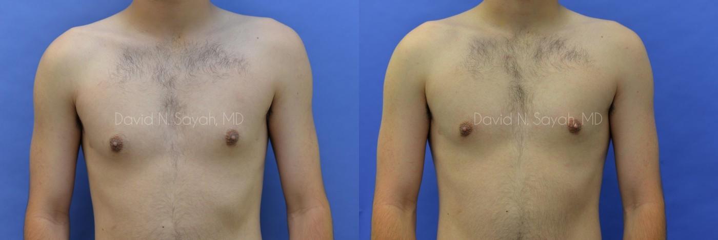 Male Breast Surgery Before and After | Sayah Institute