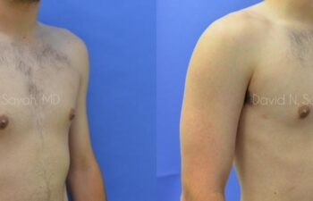 Male Breast Surgery Before and After | Sayah Institute