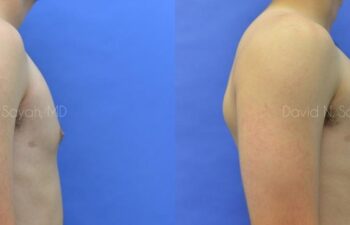 Male Breast Surgery Before and After | Sayah Institute