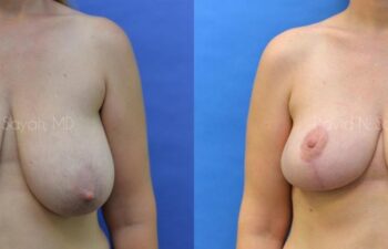Breast Lift Before and After | Sayah Institute
