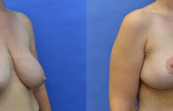Breast Lift Before and After | Sayah Institute