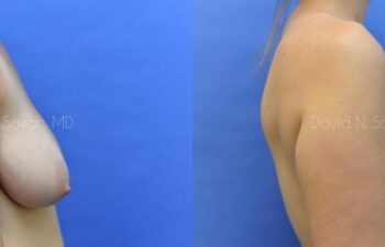 Breast Lift Before and After | Sayah Institute
