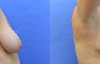 Breast Lift Before and After | Sayah Institute