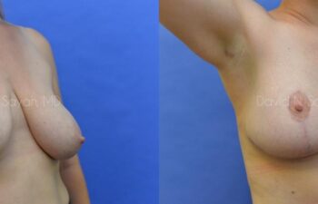 Breast Lift Before and After | Sayah Institute