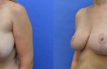 Breast Lift Before and After | Sayah Institute