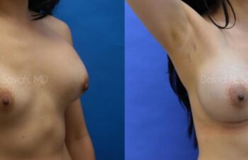 Breast Augmentation Before and After | Sayah Institute