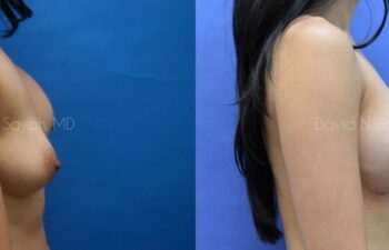 Breast Augmentation Before and After | Sayah Institute