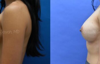 Breast Augmentation Before and After | Sayah Institute