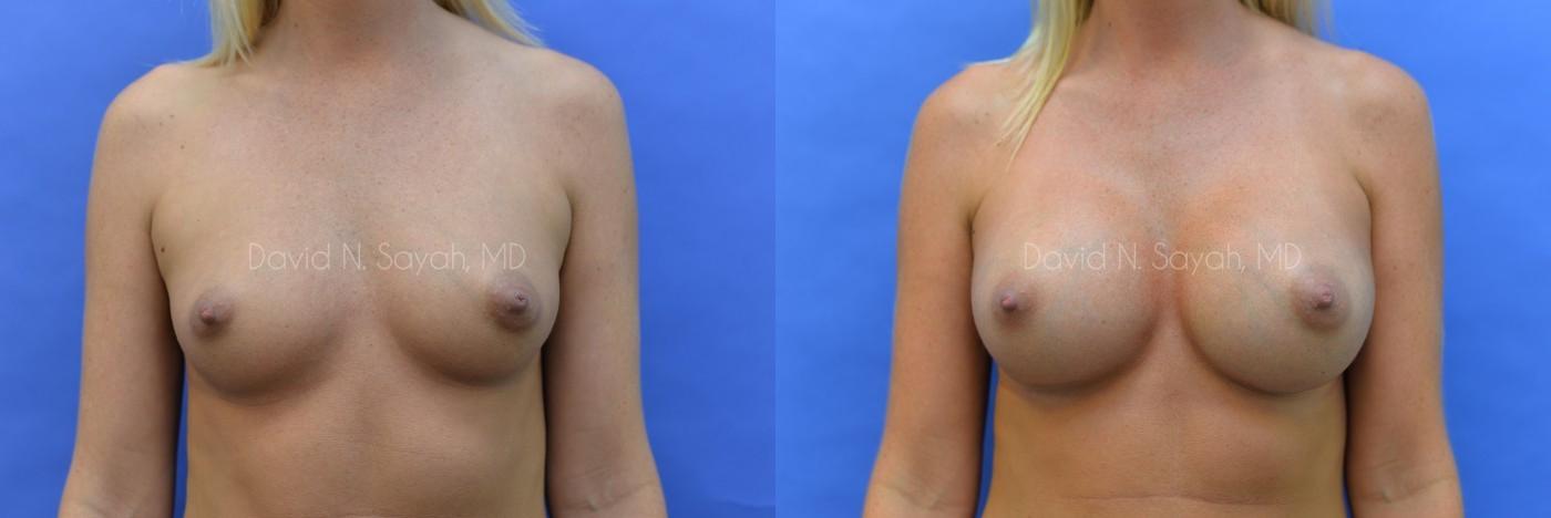 Breast Augmentation Before and After | Sayah Institute