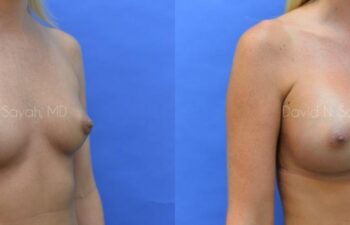 Breast Augmentation Before and After | Sayah Institute