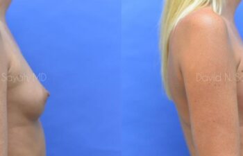 Breast Augmentation Before and After | Sayah Institute