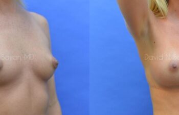 Breast Augmentation Before and After | Sayah Institute