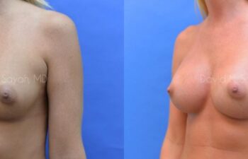 Breast Augmentation Before and After | Sayah Institute